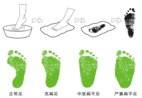 上的足印情况,来了解孩子的足部情况,如果孩子的脚内侧部分被水印填满