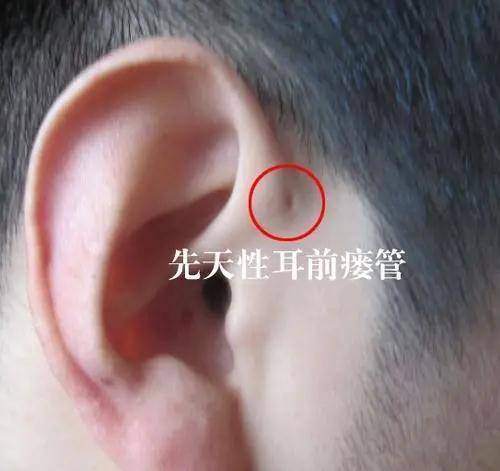耳朵上有小洞代表富贵?成都民生耳鼻喉提醒:这可能是耳前瘘管!